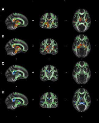White Matter Microstructural Changes and Episodic Memory Disturbances in Late-Onset Bipolar Disorder